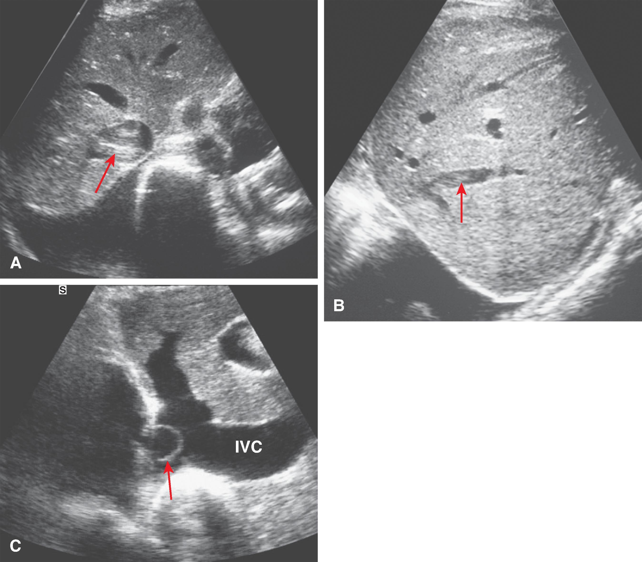 Fig. 57.6, Budd-Chiari syndrome: sonographic findings.