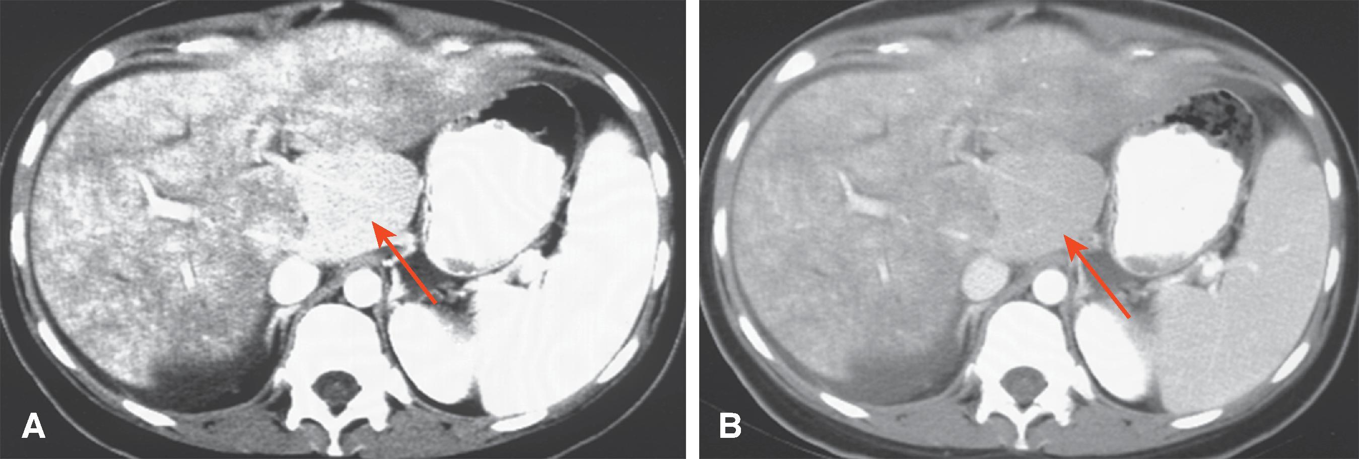 Fig. 57.7, Budd-Chiari syndrome: flip-flop pattern on computer tomography (CT).