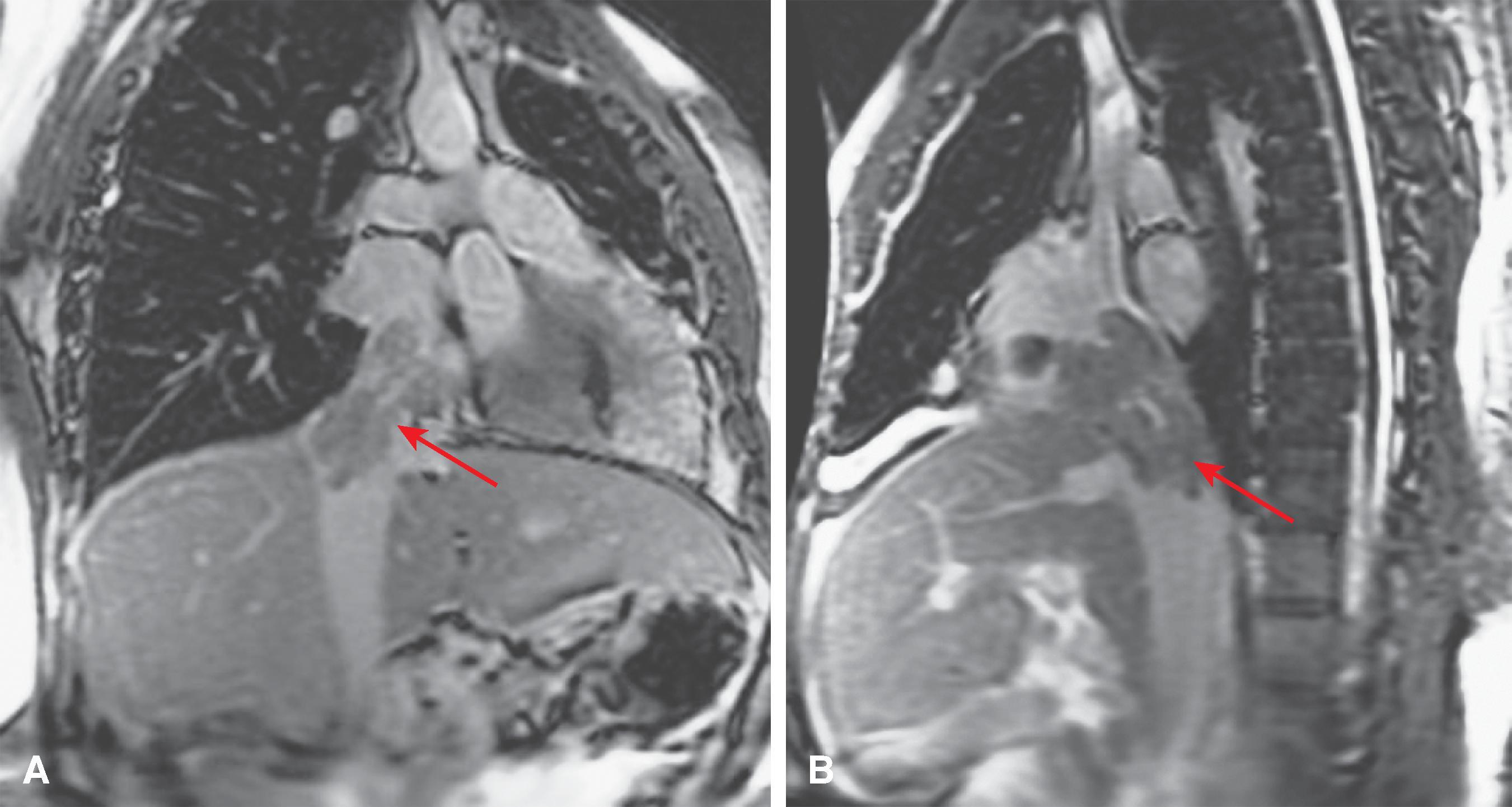 Fig. 57.8, Budd-Chiari syndrome: magnetic resonance imaging findings in a patient with hepatocellular carcinoma invading the hepatic veins and inferior vena cava.