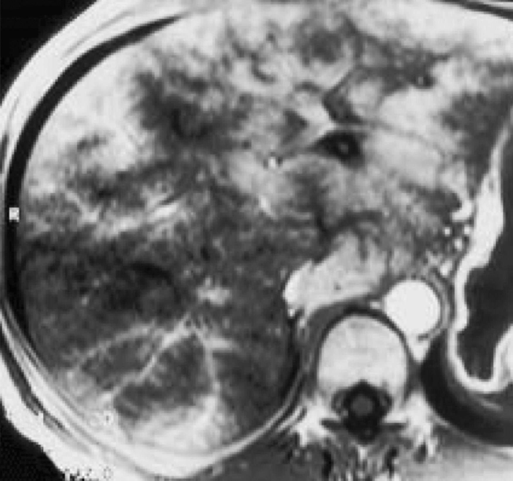 Fig. 57.9, Acute Budd-Chiari syndrome: magnetic resonance (MR) findings.