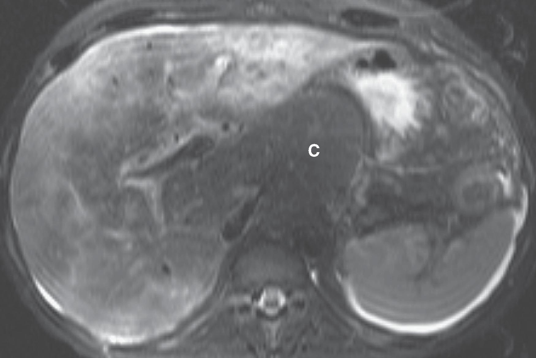 Fig. 57.10, Subacute Budd-Chiari syndrome: magnetic resonance imaging (MRI) findings.