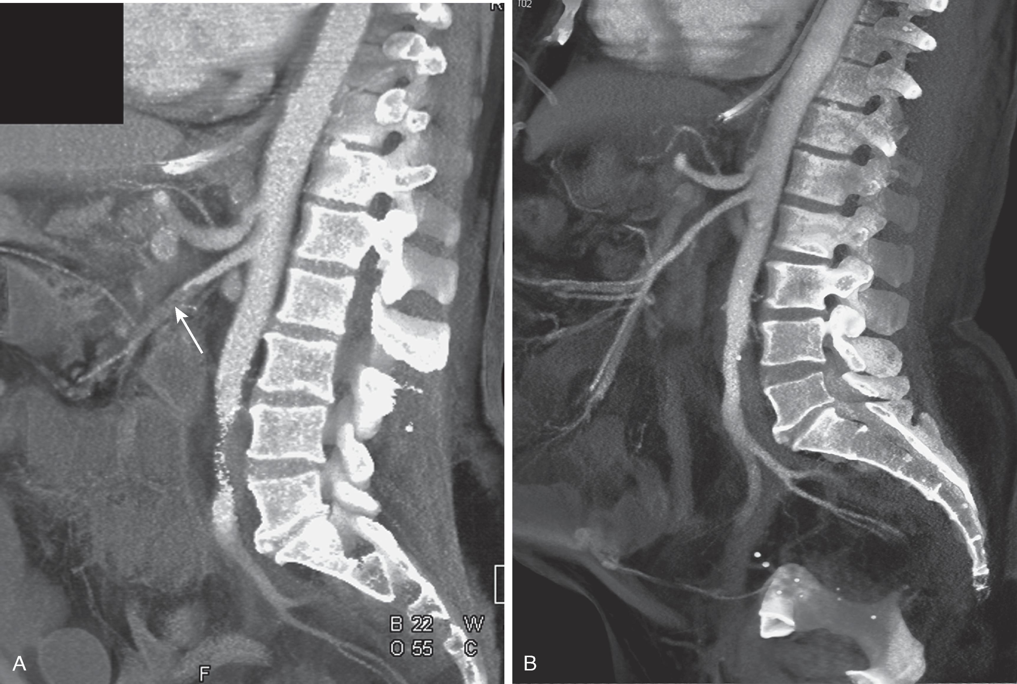 Fig. 33.1, Superior mesenteric artery (SMA) thrombosis: contrast-enhanced computed tomography (CT) images in a patient with acute abdominal pain.