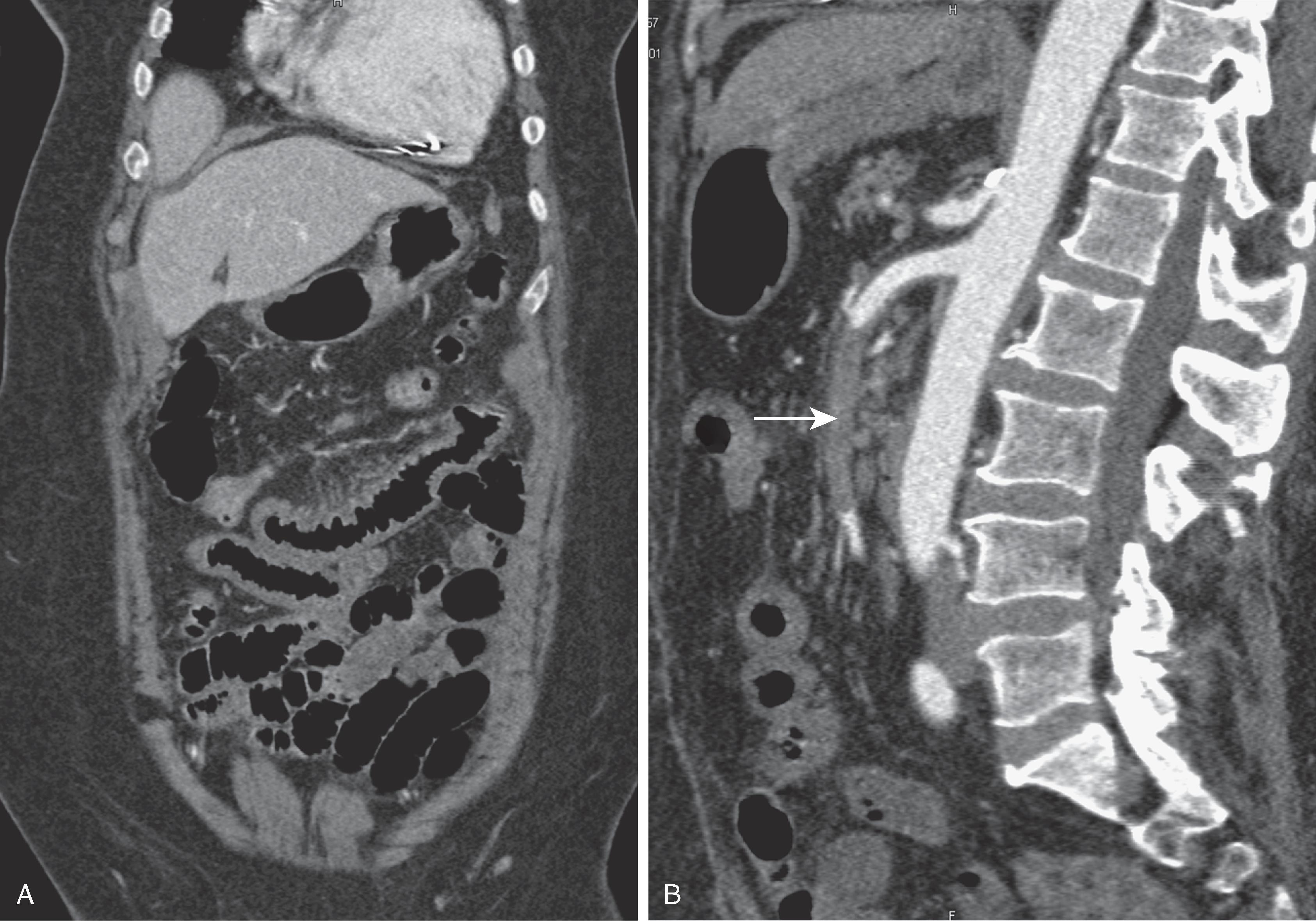 Fig. 33.2, Superior mesenteric artery (SMA) thrombus in patient with acute abdominal pain.