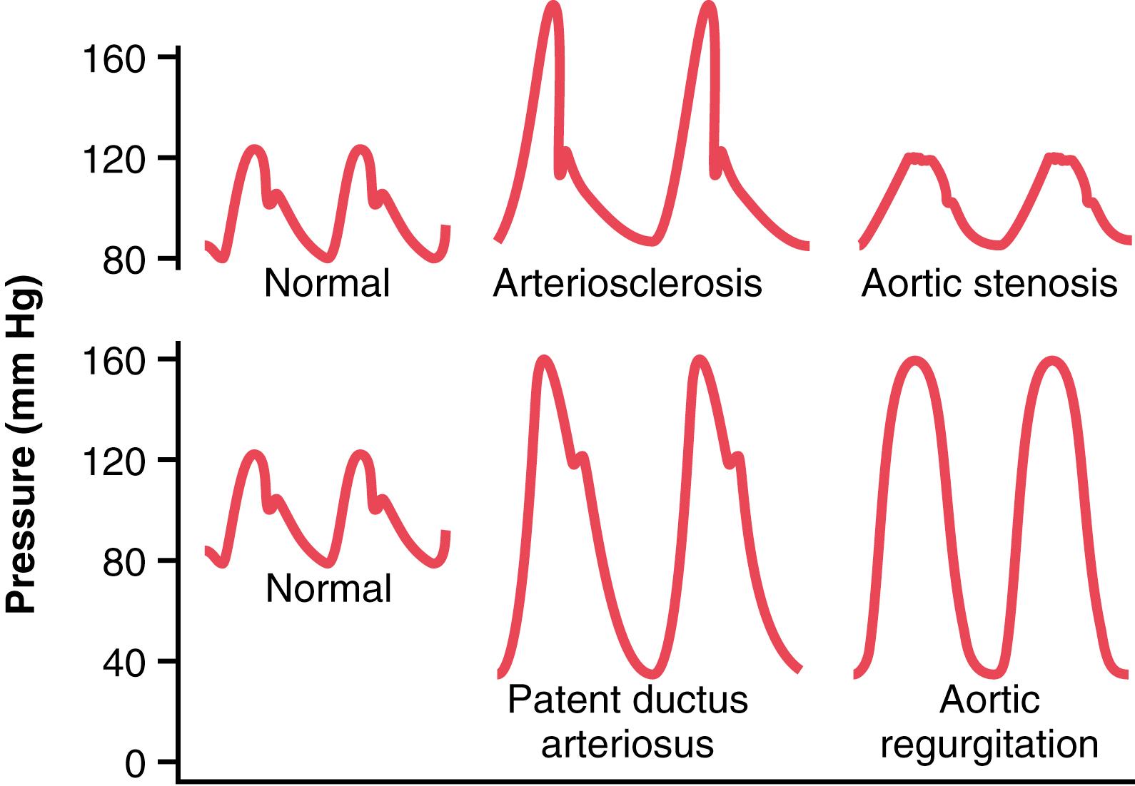Figure 15-4, Aortic pressure pulse contours in arteriosclerosis, aortic stenosis, patent ductus arteriosus, and aortic regurgitation.