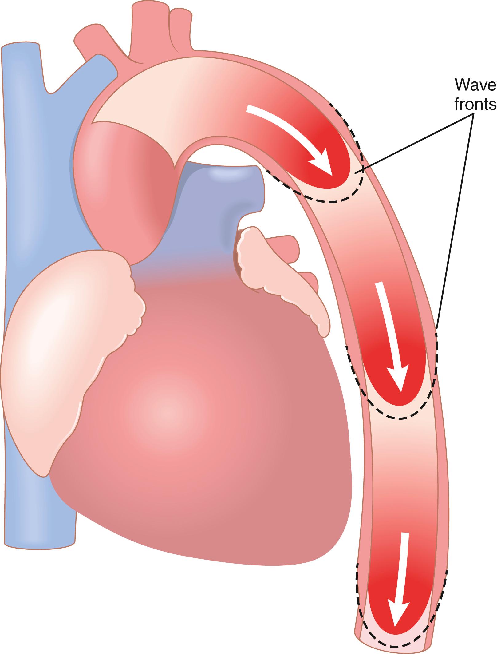 Figure 15-5, Progressive stages in transmission of the pressure pulse along the aorta.