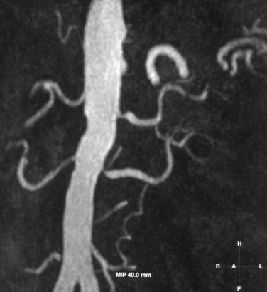 Fig. 84.1, Renal Artery Stenosis.