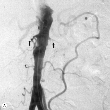 Fig. 84.2, (A) Patient presenting with acute kidney injury. Angiogram showing bilateral renal artery occlusions arrows indicated bilateral occluded renal arteries. (B) Selective left renal angiogram following successful recanalisation and stenting of the renal artery. Satisfactory renal function was re-established with a massive diuresis.