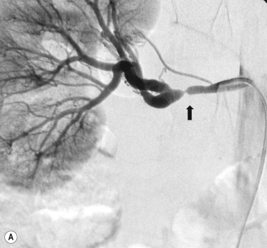 Fig. 84.3, Female Patient Aged 23 Years With Severe Hypertension.