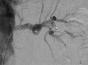 Fig. 84.4, Renal Artery Stent.