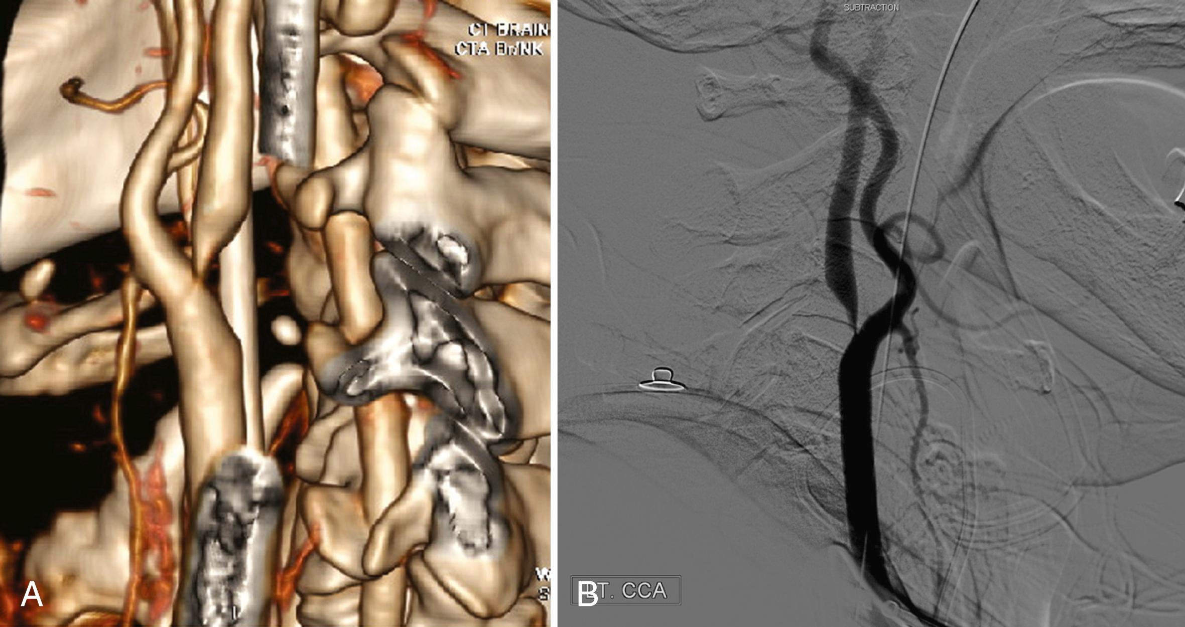 Fig. 41.1, Computed Tomographic Angiography (CTA) Compared With Digital Subtraction Angiography (DSA) in a Patient With Proximal Internal Carotid Artery (ICA) Stenosis.