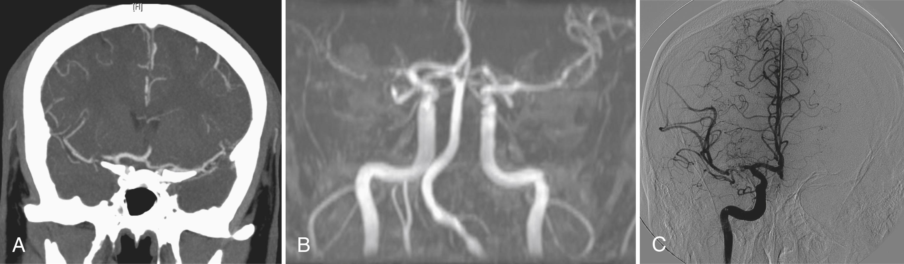 Fig. 41.2, Right Middle Cerebral Artery (MCA) Stenosis in a Patient Who Subsequently Received Intracranial Stent Placement.