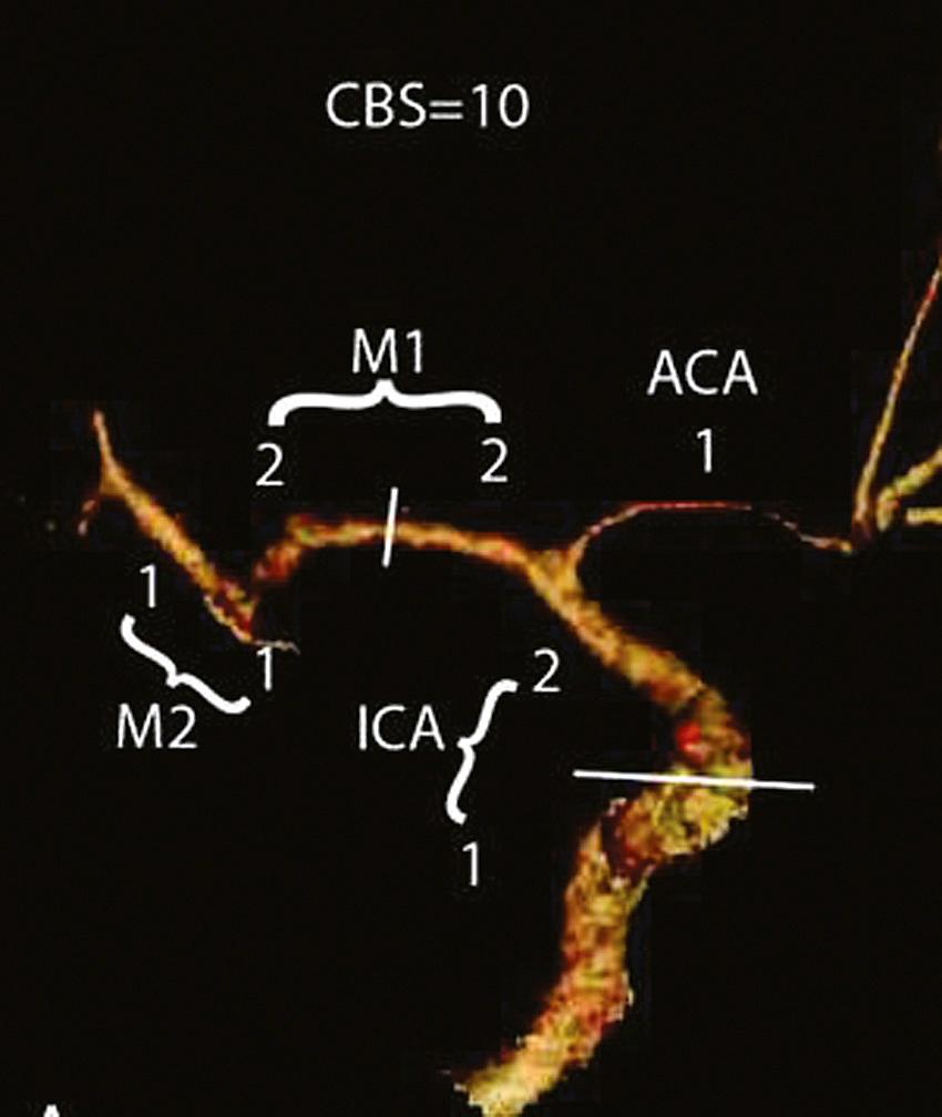 Fig. 41.3, The Clot Burden Score (CBS) on Computed Tomographic Angiography (CTA).