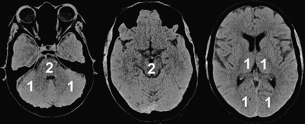 Fig. 41.5, Cerebral map defining the posterior circulation Acute Stroke Prognosis Early Computed Tomography Score (pc-ASPECTS) territories. From 10 points, 1 or 2 points each (as indicated) are subtracted for early ischemic changes or hypoattenuation on computed tomographic angiography source images in left or right thalamus, cerebellum, or posterior cerebral artery territory, respectively (1 point); and any part of midbrain or pons (2 points).