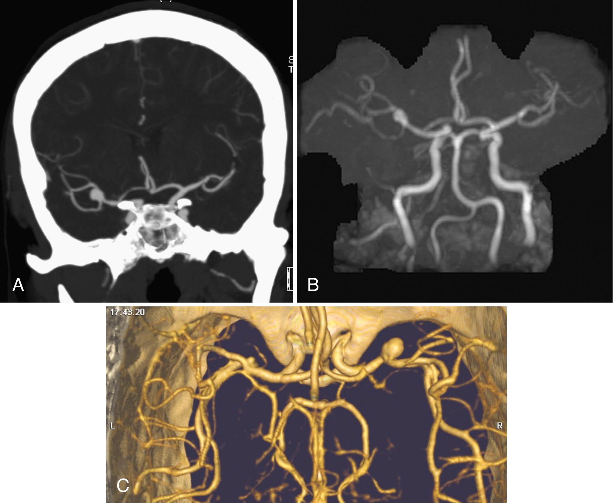 Fig. 41.6, Right Middle Cerebral Artery Aneurysm Seen on Both Computed Tomographic Angiography (CTA) and Magnetic Resonance Angiography (MRA).