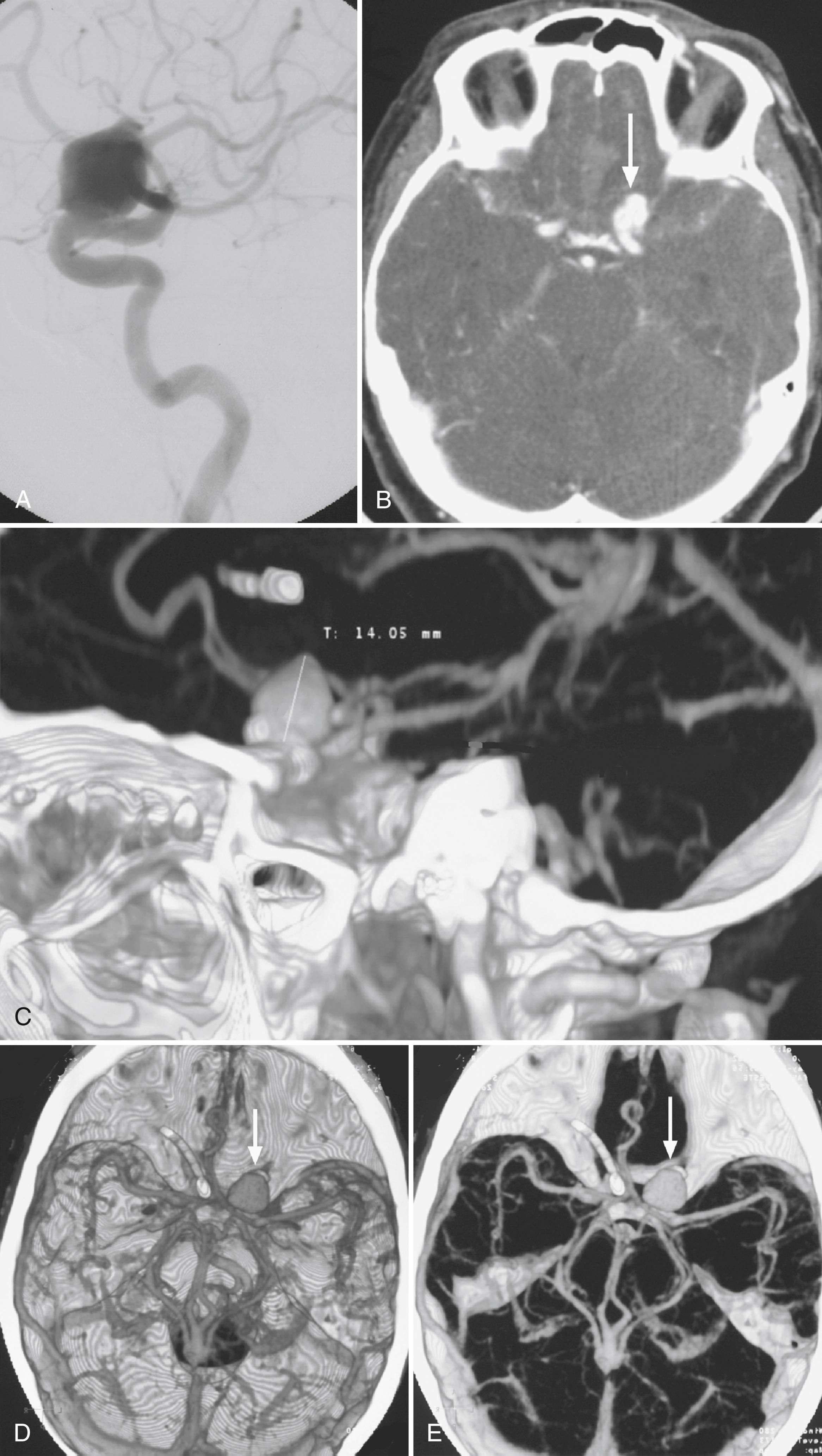 Fig. 41.7, Left Internal Carotid Artery (ICA) Aneurysm.