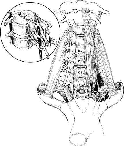 FIGURE 50-1, Schematic representation of normal vertebral artery anatomy with passage through the transverse foramina of C1 to C6. Note the midline orientation of the longus colli musculature. The inset depicts relationships of the artery within a transverse foramen, most notably with the exiting nerve root and associated uncovertebral joint.