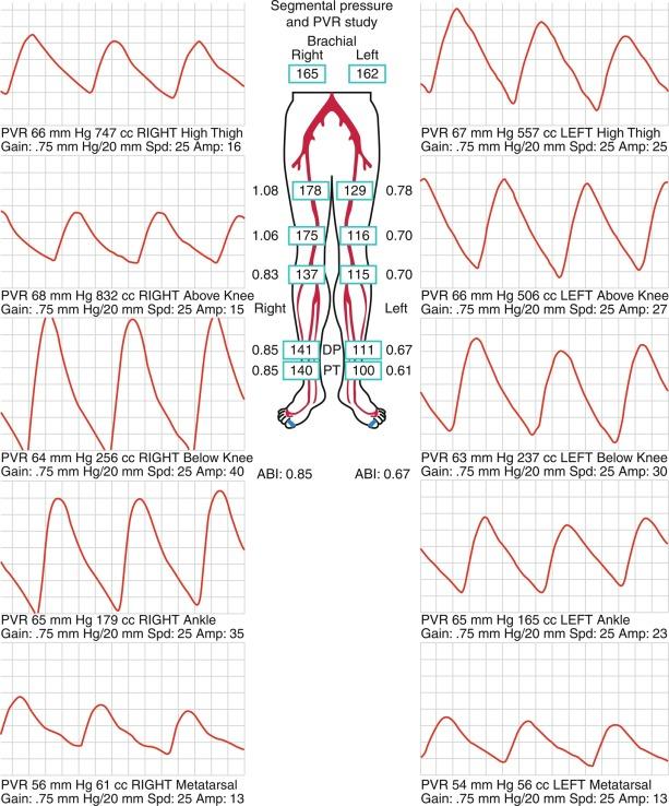 Fig. 12.1, Segmental Pressure Measurements and Pulse Volume Recording.