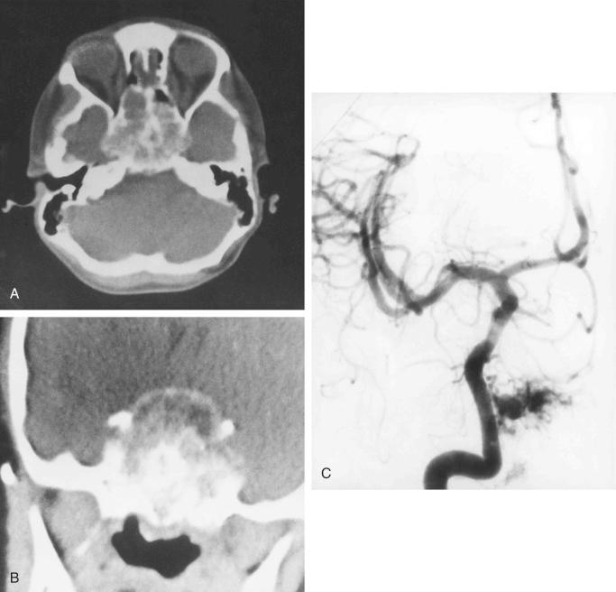 FIGURE 13-12, Hemangioma of sphenoid bone: radiographic features.