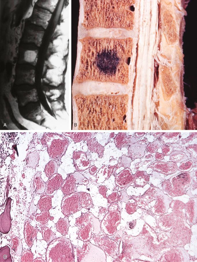 FIGURE 13-14, Hemangioma of vertebra: radiographic, gross, and microscopic features.