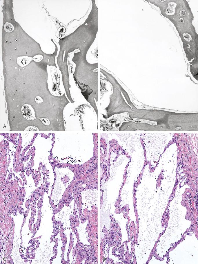 FIGURE 13-15, Lymphangiomatosis: microscopic features.