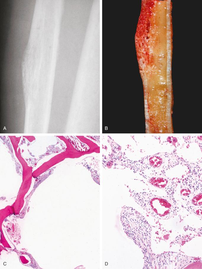 FIGURE 13-16, Lymphangioma of fibula: radiographic, gross, and microscopic features.