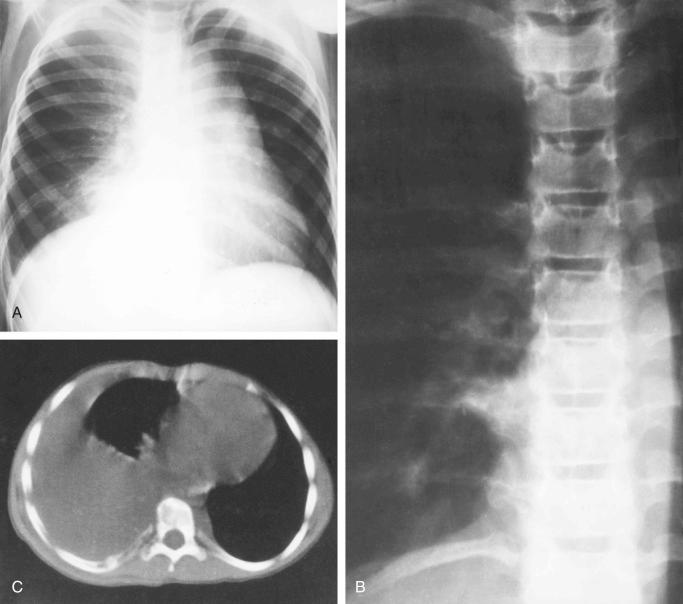 FIGURE 13-17, Lmphangiomatosis of bone: radiographic features.