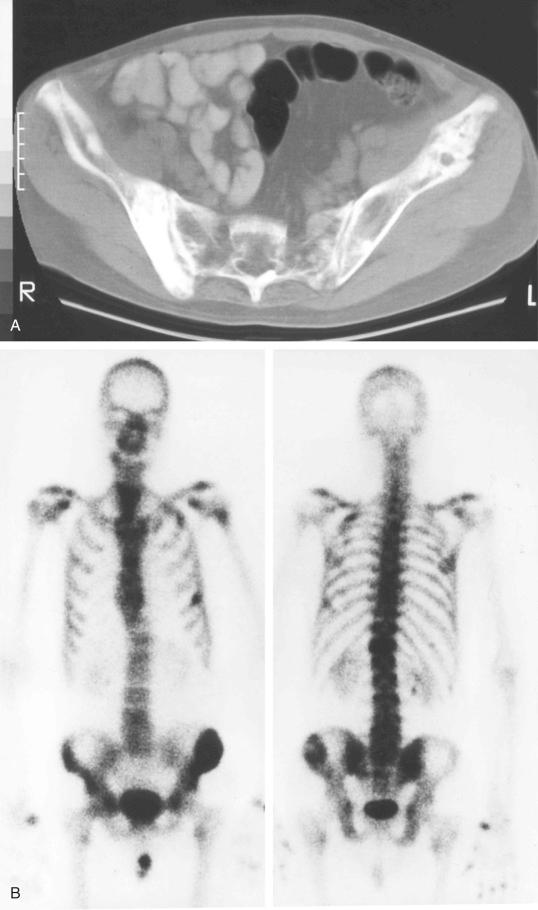 FIGURE 13-20, Cystic angiomatosis of bone: radiographic features.