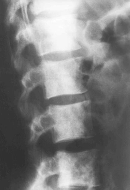 FIGURE 13-21, Cystic angiomatosis of bone (sclerotic variant): radiographic features.