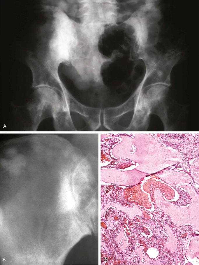 FIGURE 13-22, Cystic angiomatosis of bone (sclerotic variant): radiologic and microscopic features.