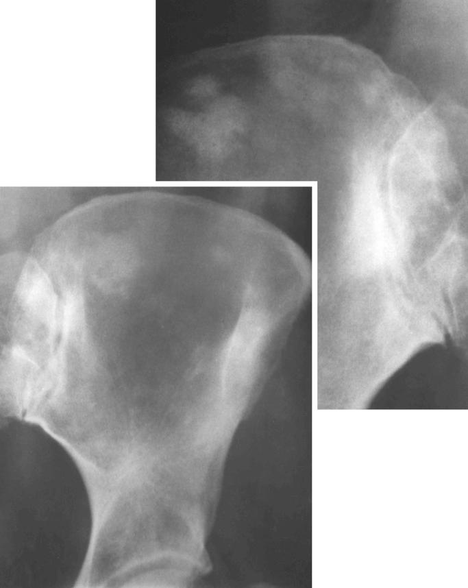 FIGURE 13-23, Cystic angiomatosis of bone (sclerotic variant): radiologic features.