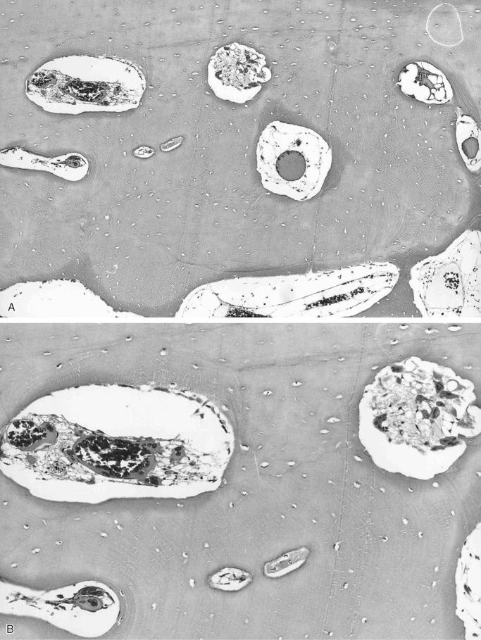 FIGURE 13-25, Cystic angiomatosis of bone (sclerosing variant): microscopic features.