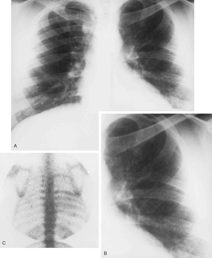 FIGURE 13-28, Massive osteolysis (disappearing bone disease) involving ribs.