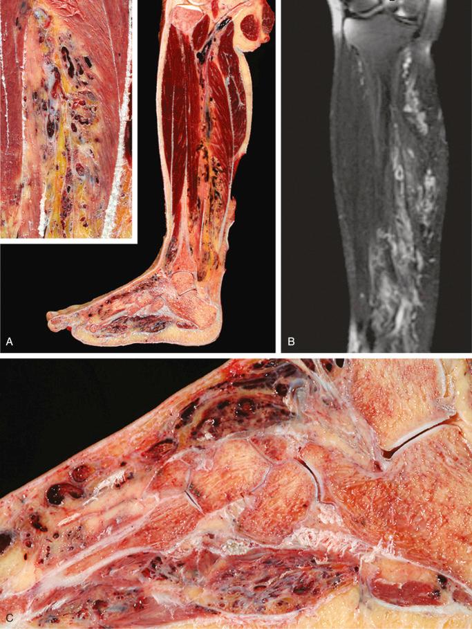 FIGURE 13-30, Vascular malformation of the lower extremity: gross and radiographic features.