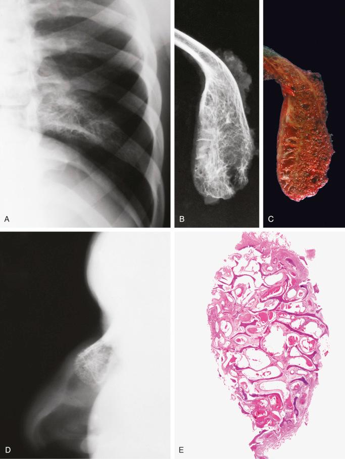 FIGURE 13-3, Hemangiomas of rib and nasal bones: radiographic, gross, and microscopic features.