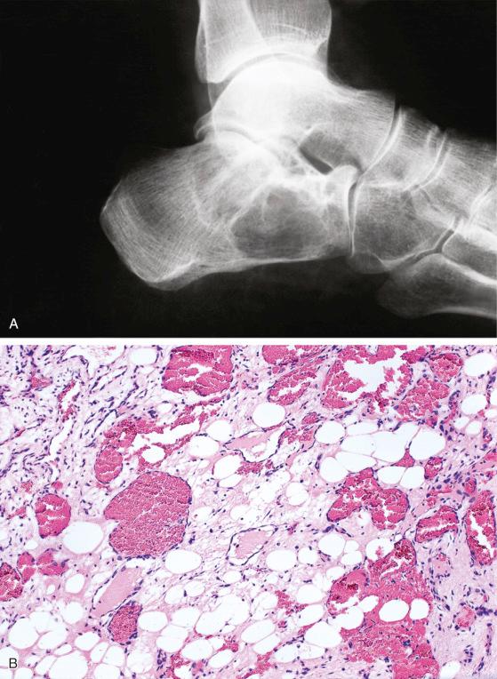 FIGURE 13-7, Calcaneus hemangioma: radiographic and microscopic features.