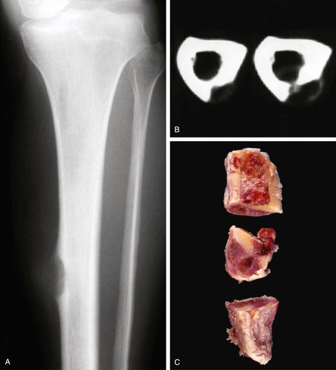 FIGURE 13-8, Subperiosteal hemangioma: radiographic and gross features.