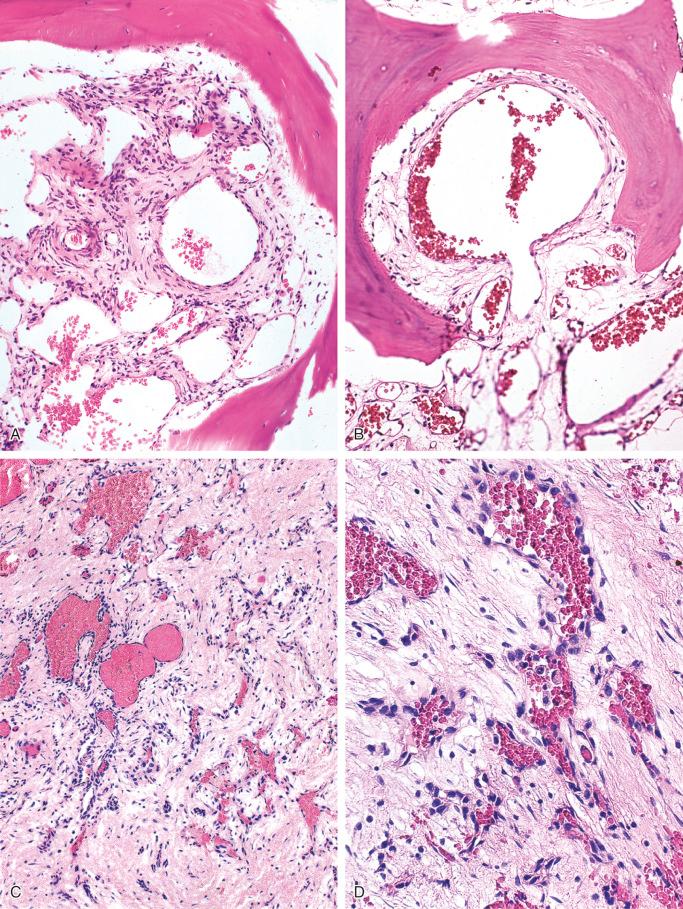 FIGURE 13-9, Hemangioma of bone: microscopic features.