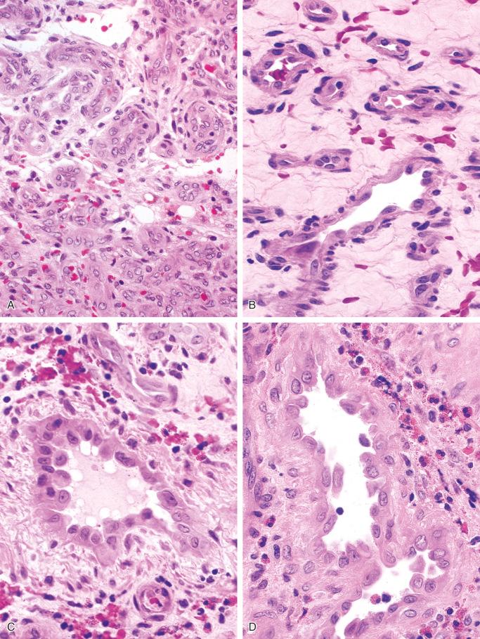 FIGURE 13-10, Epithelioid hemangioma of bone: microscopic features.