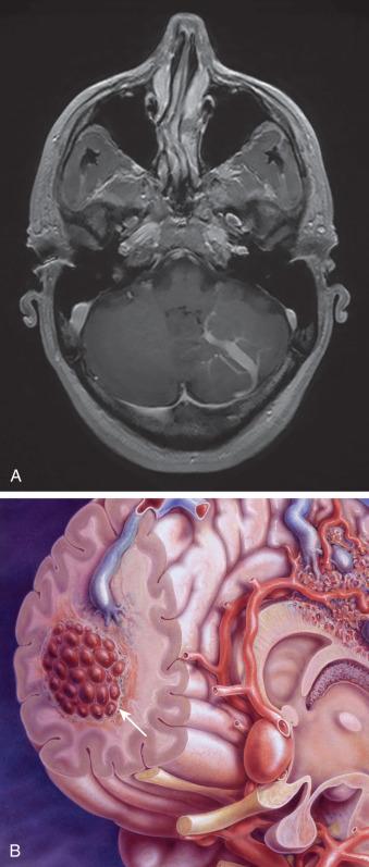 Figure 20.1, (A) On imaging, a developmental venous anomaly often appears as a straight channel topped by a starburst of feeding veins. (B) Illustration depicts the typical appearance of a cavernous malformation ( arrow ) as berry-like in configuration. Cavernous malformations can vary considerably in size and location.