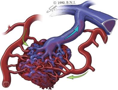 Figure 20.2, Illustration of a cerebral arteriovenous malformation, which is characterized by feeding arteries ( green arrows ), a nidus, and draining veins ( blue arrow ).