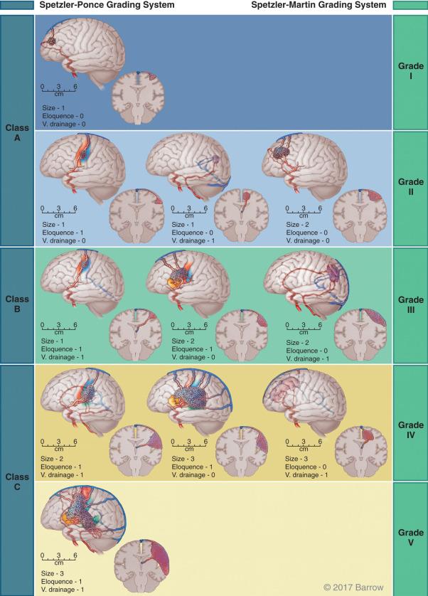 Figure 20.3, The Spetzler-Martin and Spetzler-Ponce grading systems. The Spetzler-Martin system divides arteriovenous malformations into five grades (see text). The Spetzler-Ponce system simplifies that system into just three grades, lettered A to C.