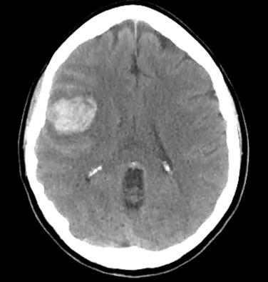 Figure 20.4, A plain axial computed tomogram showing hemorrhage. Subtle evidence of calcification suggests an underlying arteriovenous malformation.