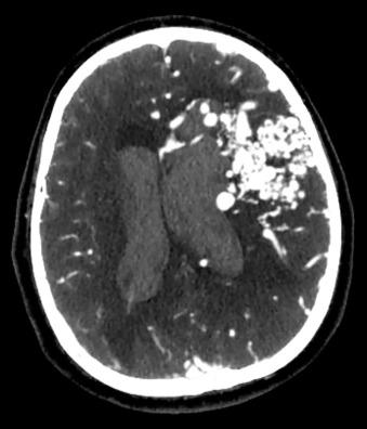 Figure 20.5, A computed tomography angiogram of a large left-hemisphere ruptured arteriovenous malformation (AVM) shows intraventricular blood and the prominent tangle of vessels that constitute the AVM.