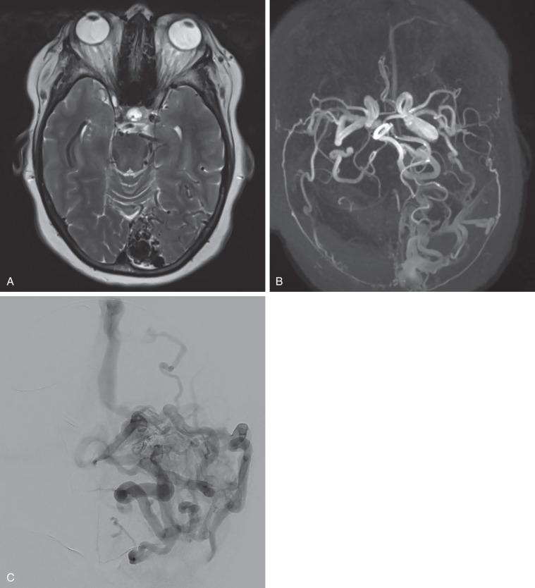 Figure 20.6, (A) An axial T2-weighted magnetic resonance image (MRI) shows a left occipital arteriovenous malformation (AVM). The AVM appears dark on T2-weighted MRI because of the presence of “flow voids.” (B) A magnetic resonance angiogram of the same AVM shows only the vessels of the AVM, with the brain not visible in the image. (C) An anteroposterior angiogram of the same AVM is shown for comparison.