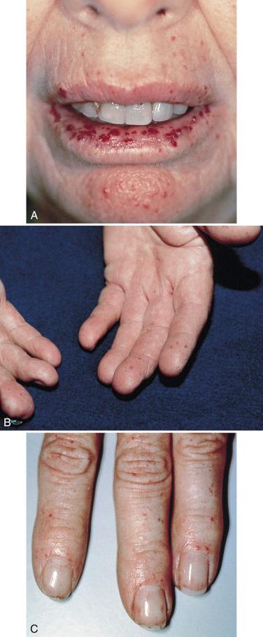 FIGURE 23-3, Papular telangiectasias of the lips ( A ), fingers ( B & C ), and nailfolds ( C ) in two patients with hereditary hemorrhagic telangiectasia (HHT).