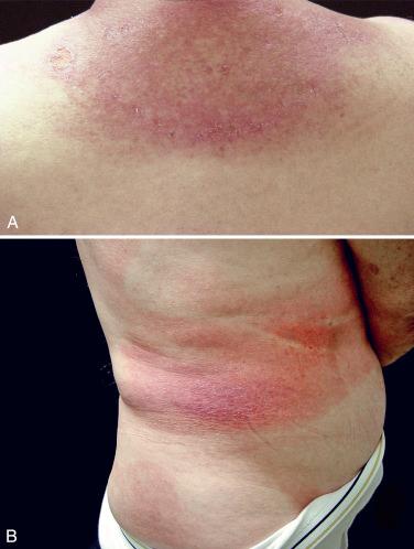 FIGURE 23-4, A, Poikiloderma of the upper back (shawl sign) in a patient with dermatomyositis. B, Poikiloderma in a patient with early cutaneous T-cell lymphoma. The latter photograph was taken over 20 years ago, and this patient’s disease has been controlled with the application of moderately potent corticosteroids.