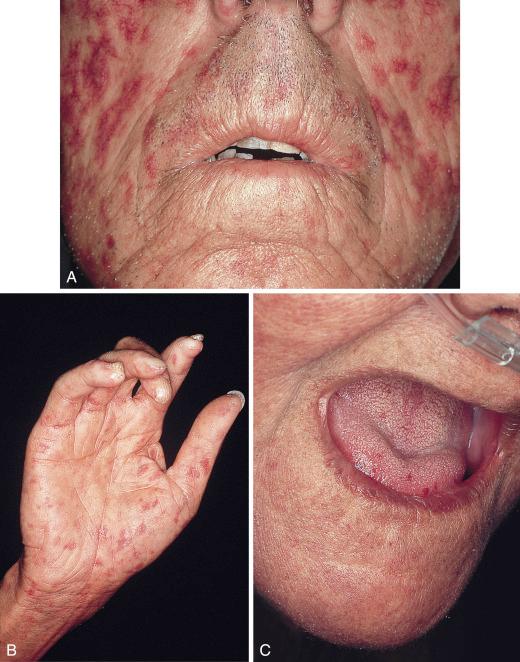 FIGURE 23-5, Mat telangiectasias of the face, tongue, and hand in two patients with scleroderma. Note the perioral furrowing in A, and the sclerodactyly and loss of distal digits in B .