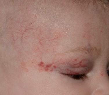 FIGURE 23-16, Segmental minimal-growth infantile hemangioma associated with PHACE(S) syndrome.