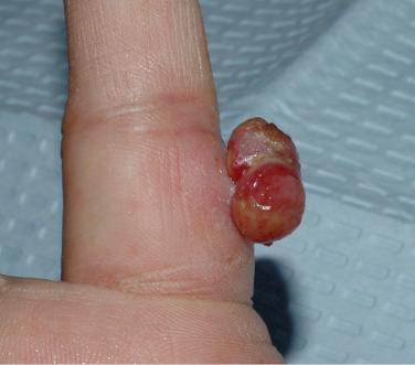 FIGURE 23-7, Pedunculated pyogenic granuloma of the finger at a site of trauma. The beefy red appearance is reminiscent of granulation tissue.