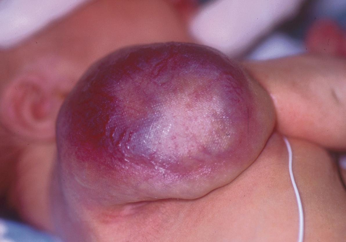 Fig. 94.4, Kaposiform hemangioendothelioma complicated by Kasabach–Merritt phenomenon.